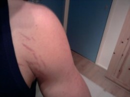 stretch marks